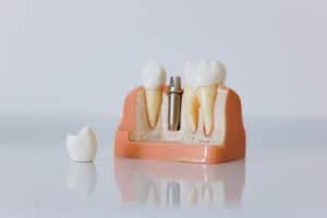 implant-diş